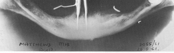 3 Stabilizers are most successful in mandibular anterior region