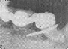 1 Mesially tipped mandibular molar stabilized by endodontic stabilizer
