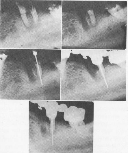 2 Endodontic stabilizers stabilize remaining root if other roots removed