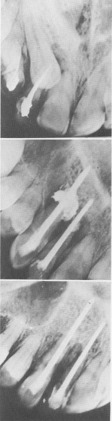 3 Endodontic stabilizers also used in conjunction with reimplanted teeth