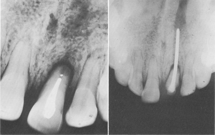 1 Maxillary incisor root treated, reimplanted, & externally splinted
