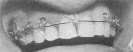 2 Accident leading to loosening of upper right lateral incisor 