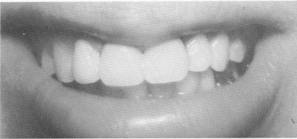 1 Completed porcelain fused to metal splint support reimplanted tooth