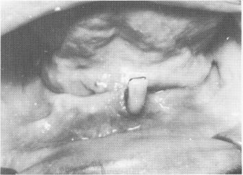 2 Postoperative radiograph after endodontic pin implant placement