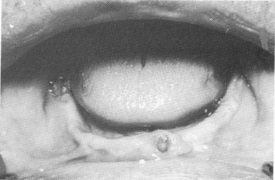 3 only loose lateral incisor & second molar remaining in lower arch