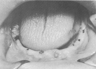 4 Lower lateral incisor and molar prepared for full coverage