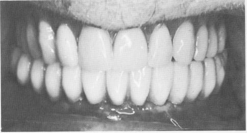 1 Full arch fixed denture cemented over the abutments