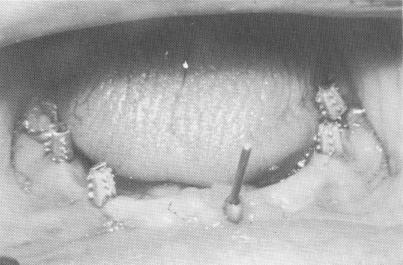 2 Panorex roentgenogram shows endodontic implant stabilizer & implants