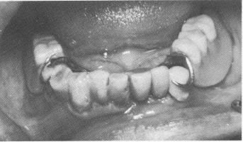 4 Three loose lower teeth supported with endodontic stabilizers
