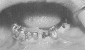 1 Castings set on abutment teeth & ventplants set into osseous structure