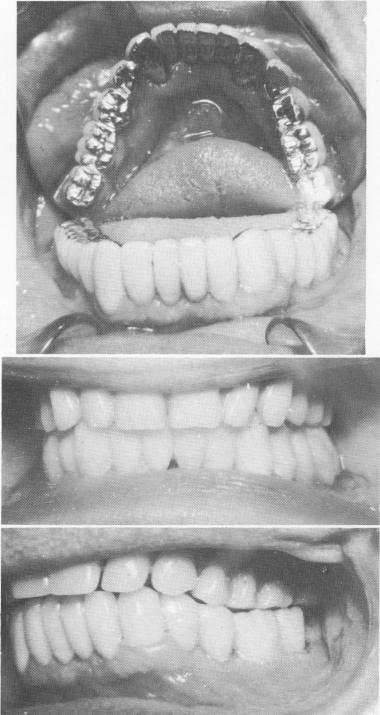 2 Gold occlusal acrylic veneer denture on endodontically stabilized teeth