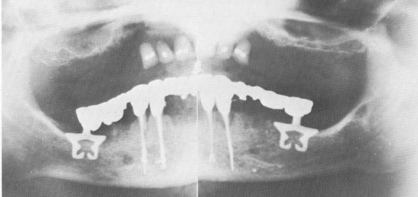 2 Full arch restoration on stabilized anterior teeth & posterior blades  