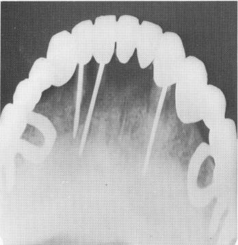 1 Endodontic stabilizers in the anterior part of mandible