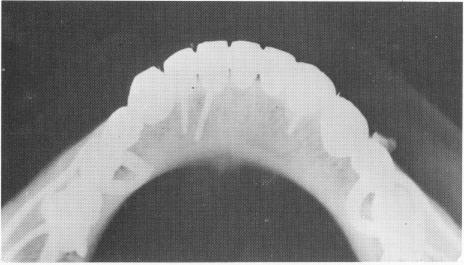 2 Bilaterally placed subperiosteal implants in posterior mandible