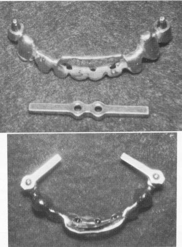 3 Strategically situated roots supported with endodontic stabilizers
