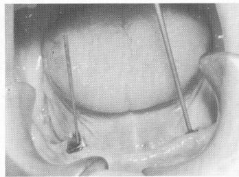 4 Mandibular scalloped template with Gerber spring type attachments