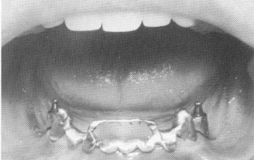5 Scalloped template supported by gold post copings on premolar roots