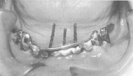 1 Three pin implants drilled through holes made in mandibular template