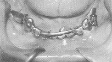 2 Excess length of extending dental pin implants was cut away