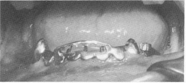 3 Pins bent underneath inverted U shaped bar of mandibular template