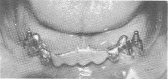4 Dental pins fused & locked between inverted bar & scalloped template 