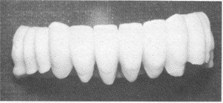 5 Mandibular acrylic full arch splint