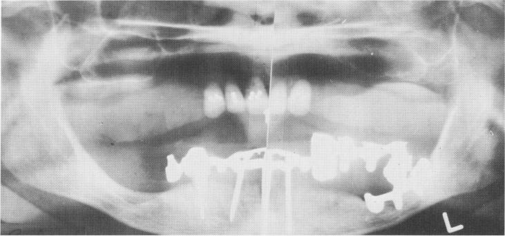 1 Left bicuspid removed & replaced with unilateral subperiosteal implant