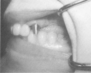 2 Cuspid with complete horizontal fracture of root fitted with gold post