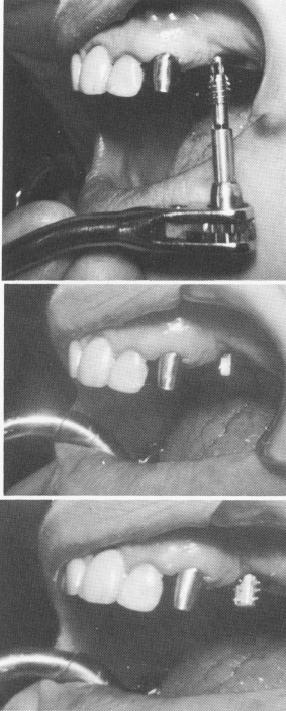 3 Ventplant tapped in edentulous bicuspid region behind cuspid post