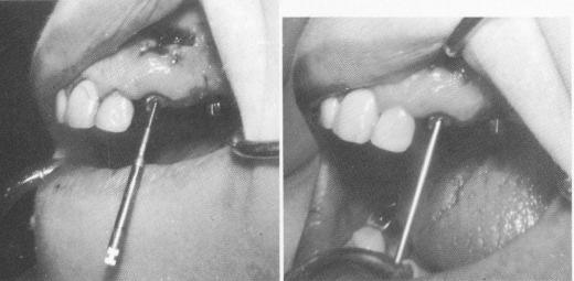 1 Endodontic root stabilizer placed inside cuspid root