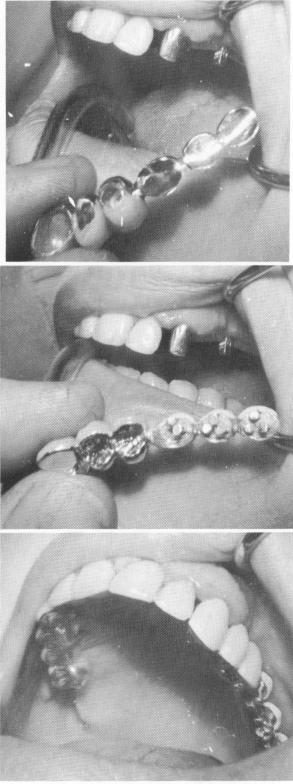 2 Maxillary bridge with scalloped template fitted into position