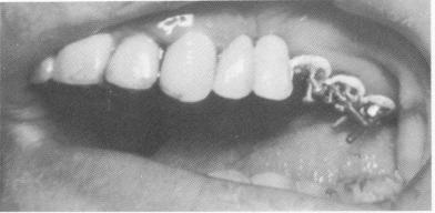 3 Pin implants driven through openings in maxillary template
