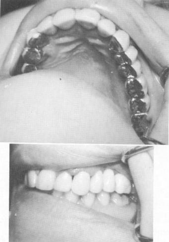 4 Superstructure cemented over maxillary template with triplant pins