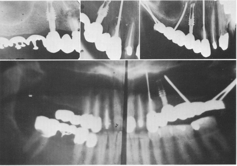 1 Endodontic implant stabilizer seen six months after apicoectomy