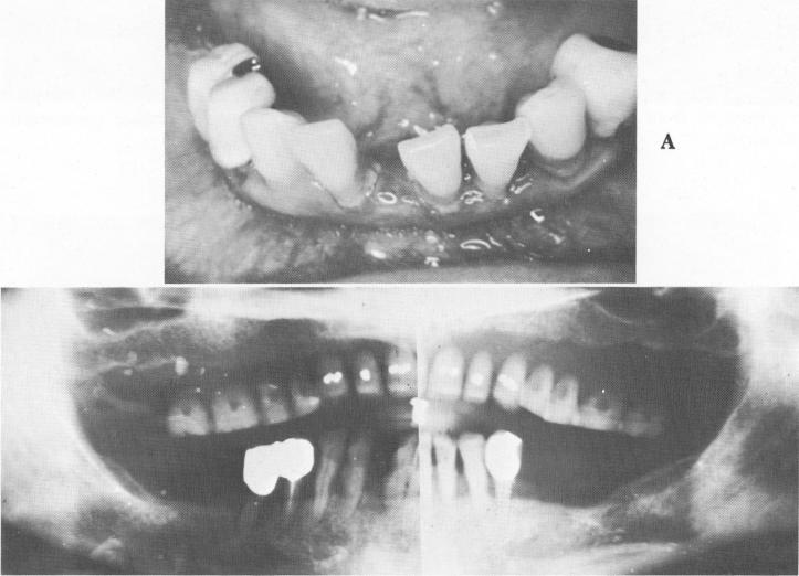 2 Occlusal x ray shows endodontic implant stabilizer,ventplant & triplant