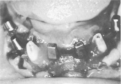 1 Four blade implants tapped into mandibular arch