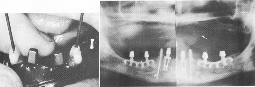 2 Rubber dams used while endodontic stabilizers introduced into cuspids