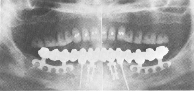 3 Immediate postoperative x ray after seating endodontic stabilizers