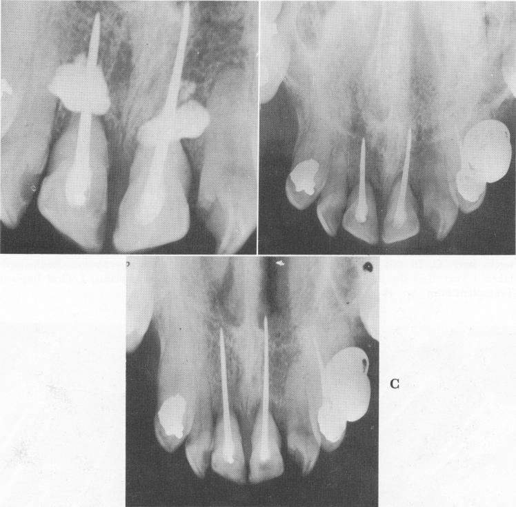 1 Excess amount of cement pushed apically beyond bore holes in maxilla