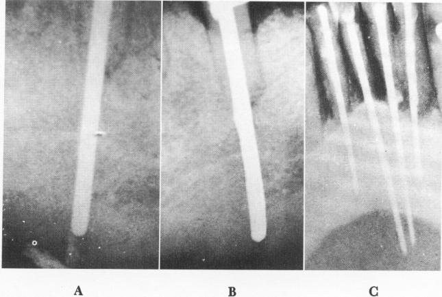 1 Post overshot lower premolar & went through jaw, immediately withdrawn