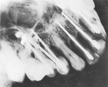 2 Implant pins perforating the maxillary sinus