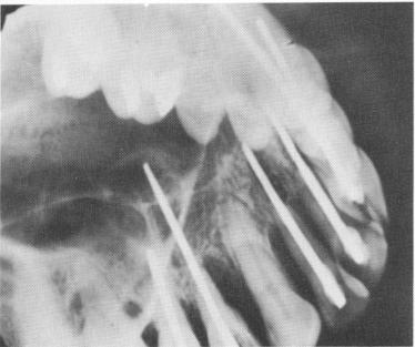 3 Pins perforating the nasal vestibulum as well as the sinus