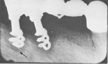 1 Bone resorbs rapidly when open spirals not deeply buried in jaw bone