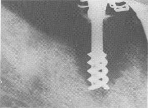 2 V shaped breakdown of jaw bone associated with soft tissue invagination