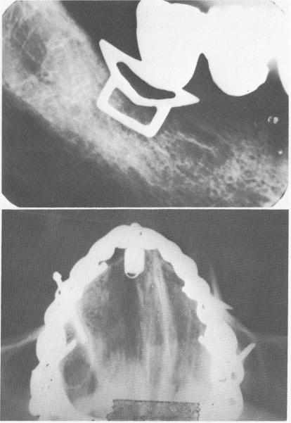 3 Blade implant shoulder not buried below alveolar crest of jaw bone