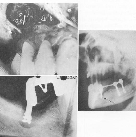 1 Labial plate perforation by pin seen after retracting mucoperiosteum