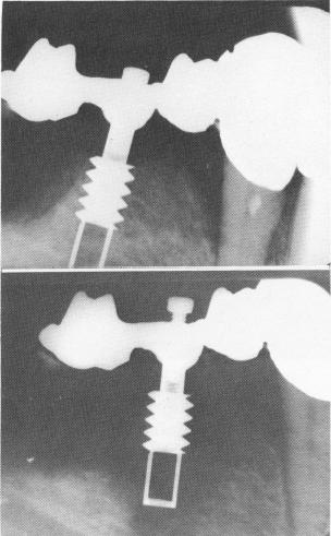 1 Vent plant placed too close to open tooth socket