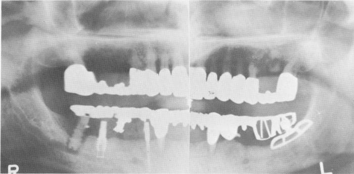 1 Failing crystalline bone screw in mandibular jaw & its causes