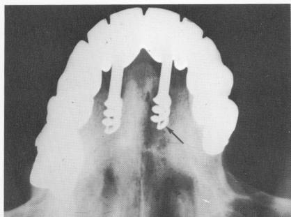1 Broken narrow ridge implant seen leaning towards neighboring tooth