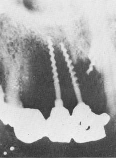 2 Upper left implant perforated labial plate of bone in maxilla